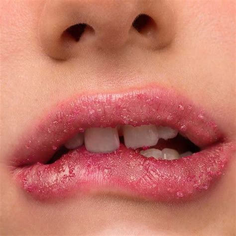 dudak çatlaması hangi vitamin eksikliği